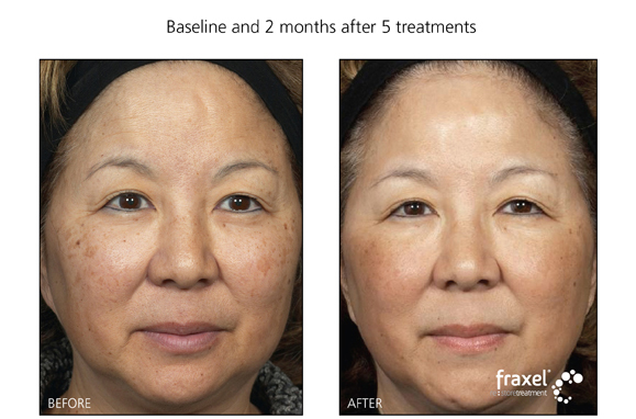 Laser Treatment for sundamage and pigmentation for residents of PA, NJ and NY