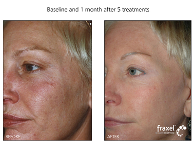Laser treatment for Sundamaged and pigmentation. Call now, 570-296-4000 for more information