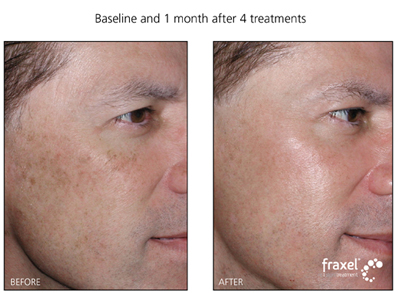 Fraxel Laser Treatment for sundamaged and facial pigmentaion