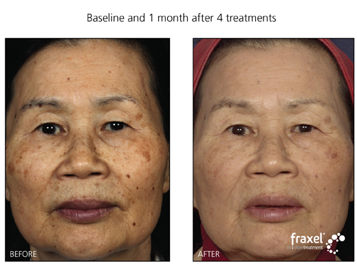 Fraxel Laser Treatment for residents of Pennsylavania, New Jersey and New York