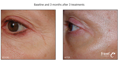 Fraxel Laser Treatment for Facial Wrinkles