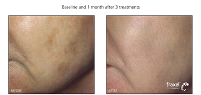 Laser treatment at Advanced Dermatology Milford